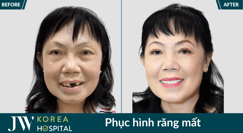 phuc hinh rang mat