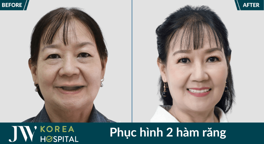 phuc hinh rang mat 2 ham