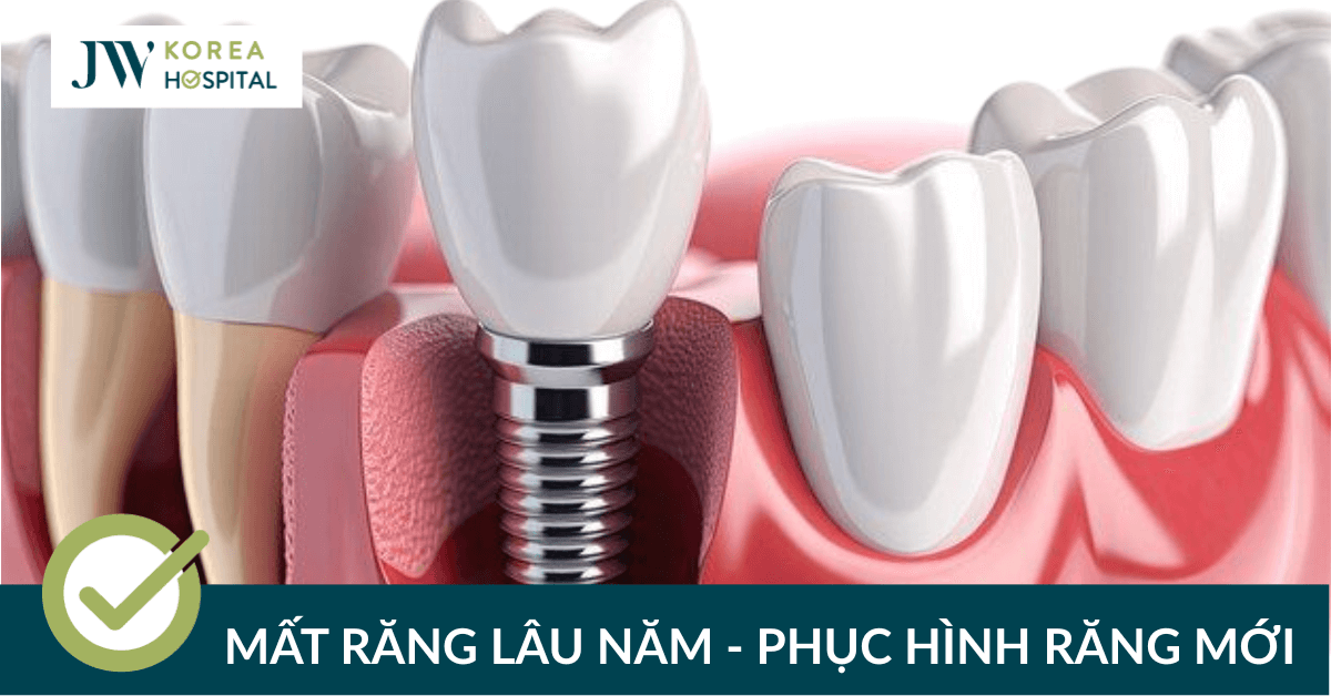 Phục hình răng mới tại bệnh viện JW: nhanh chóng, bền đẹp, giá tốt nhất năm