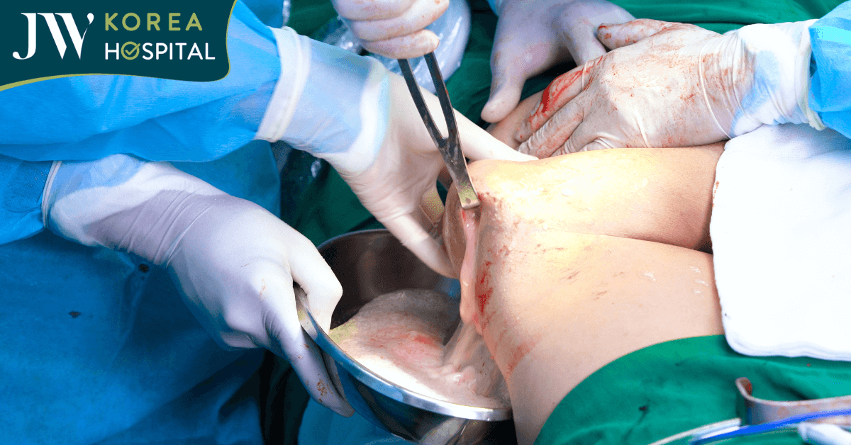 Lần đầu tại Việt Nam: Ứng dụng siêu âm AI nạo Filler mông, đùi