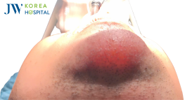 thumb nao filler cam