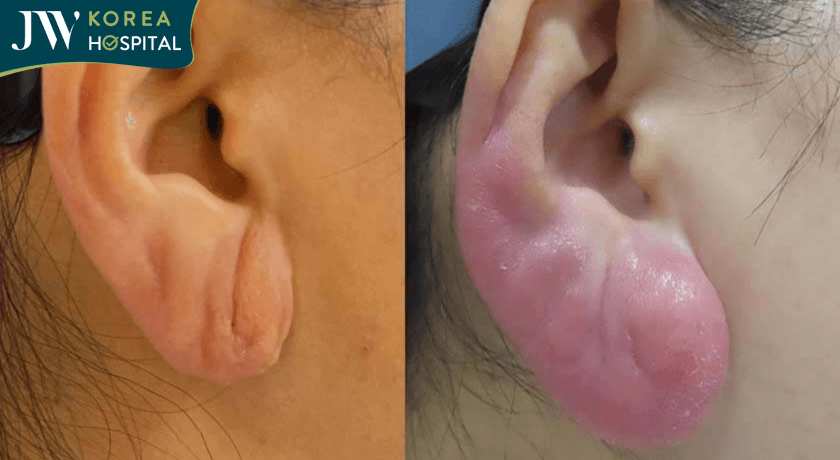 tiem filler 6