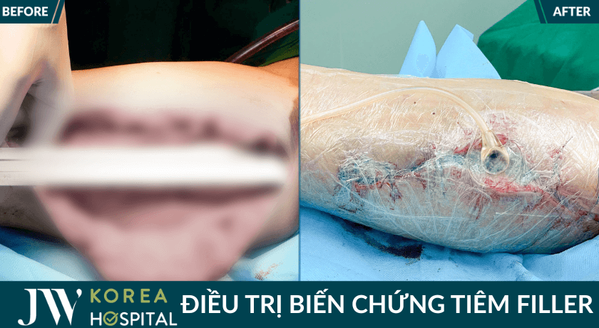 truoc va sau tiem filler duoc jw dieu tri 1