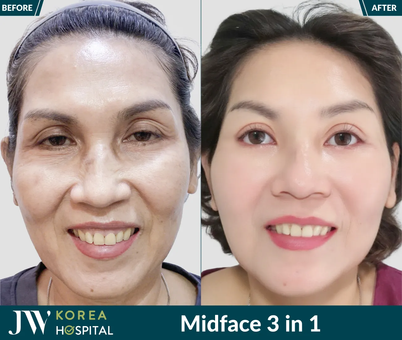 Midface 3 in 1 01 T08 2025 216x183