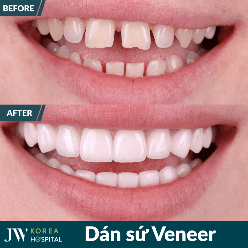 dan su veneer jw 