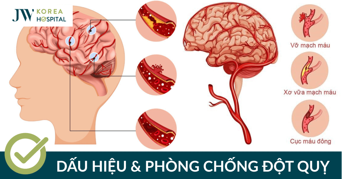 Đột quỵ: Dấu hiệu nhận biết & cách phòng ngừa cùng JW