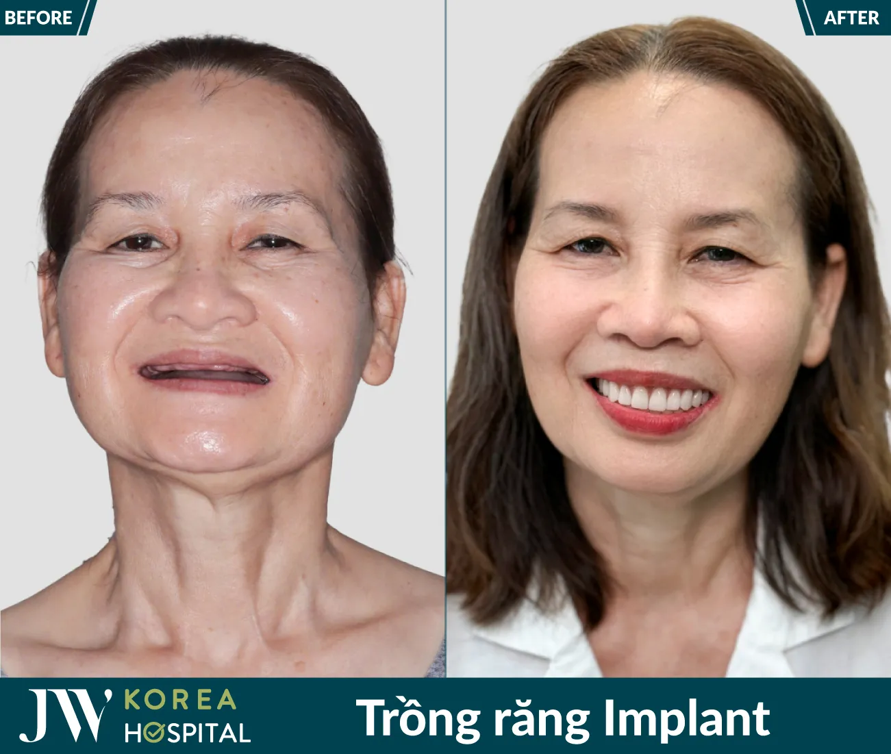trong rang implant 