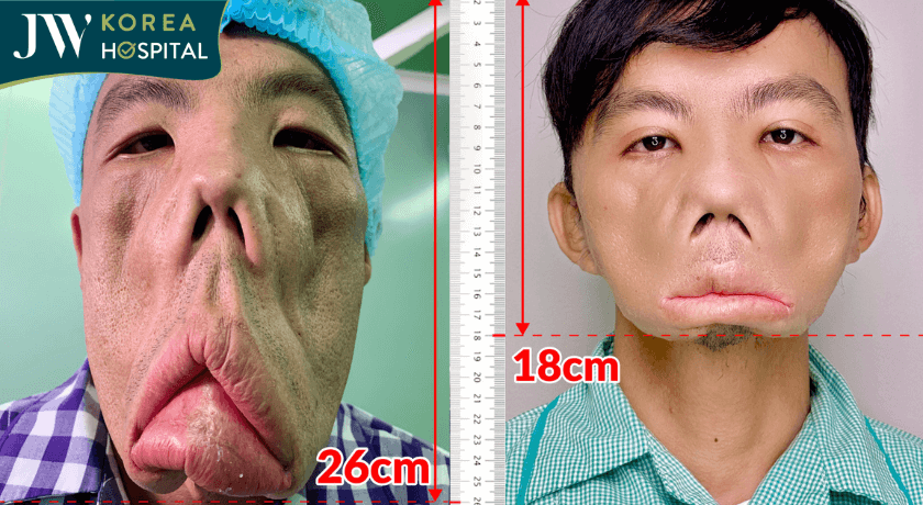 anh mến bệnh MRS trước và sau bác sĩ tú dung phẫu thuật
