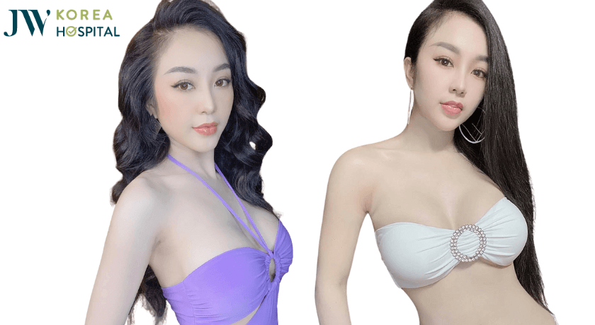 hình ảnh khách hàng tái phẫu thuật nâng ngực tại bệnh viện jw