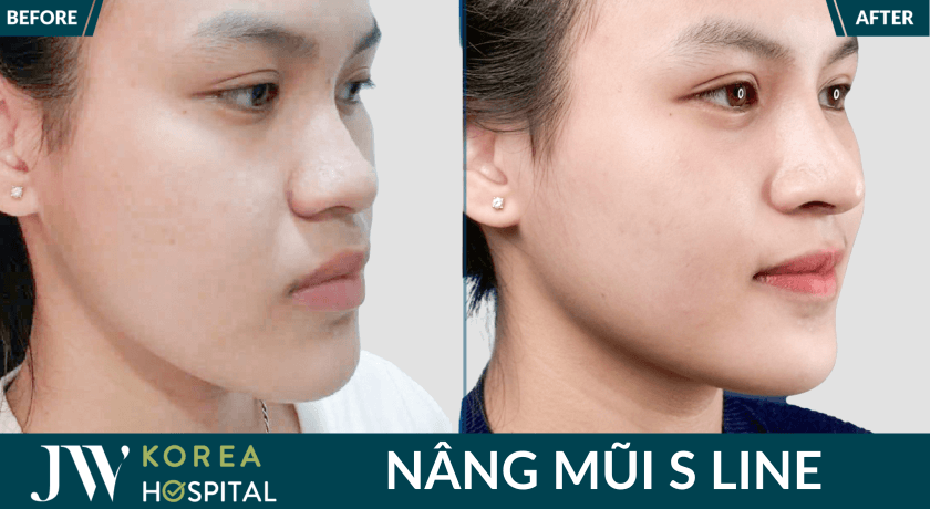 canh mui thon gon sau nang mui tai jw