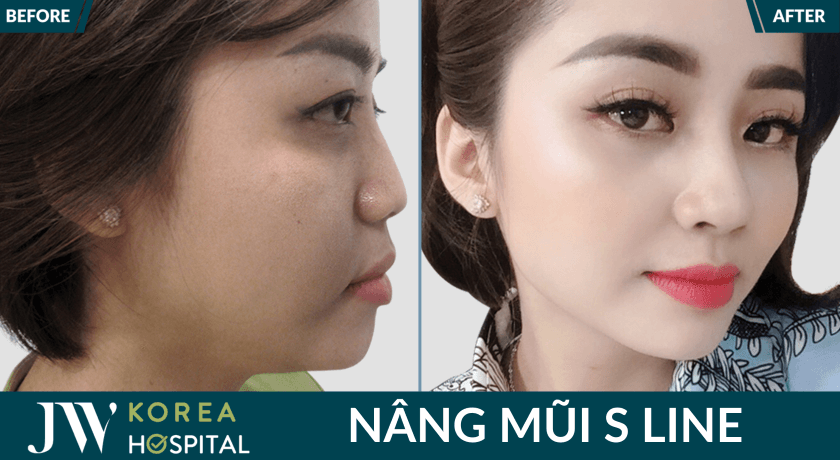 mui dep tu nhien sau nang mui tai jw