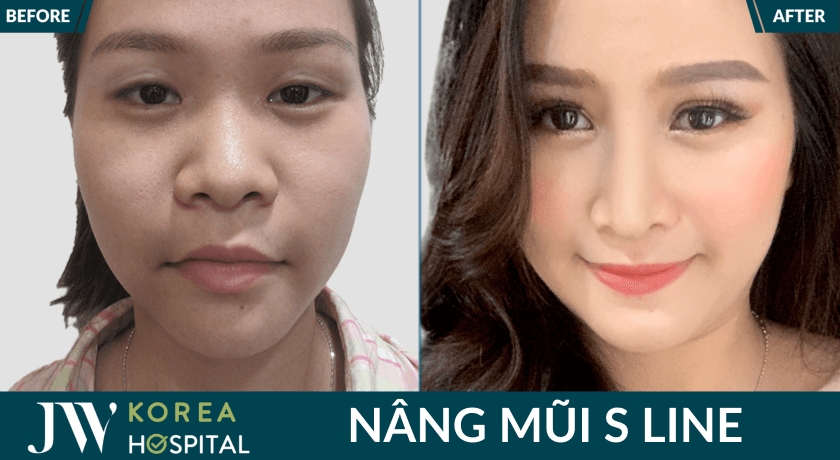 canh mui thon gon, song mui cao sau nang mui tai jw 