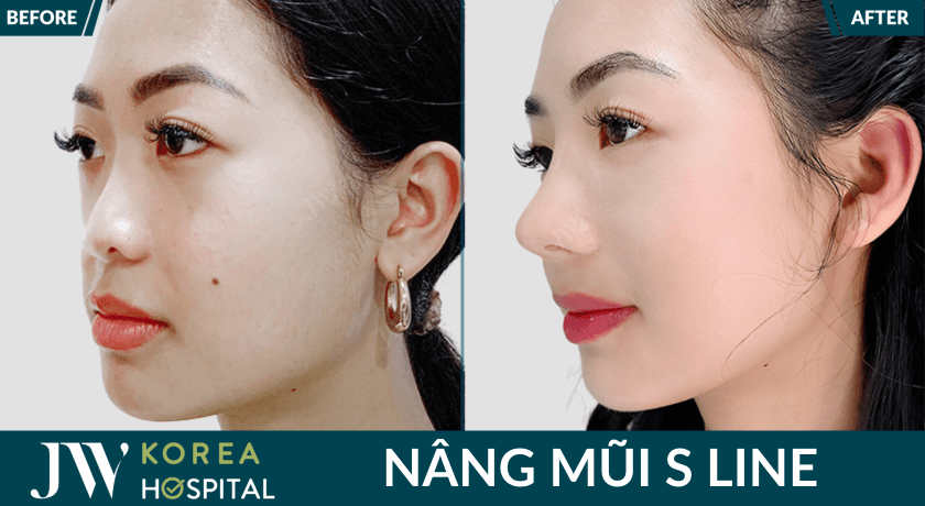 nang mui an toan, dep tu nhien sau nang mui tai jw 