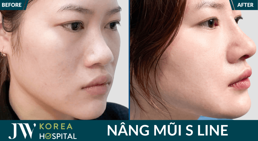 so huu dang mui cao sang sau nang mui tai jw