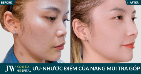 Nâng mũi trả góp: Tìm hiểu ưu – nhược điểm, vì sao khách hàng chọn Nâng mũi tại Bệnh viện JW Hàn Quốc