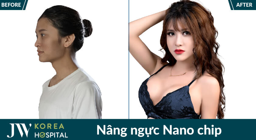 Nâng ngực nano chip cho người chuyển giới