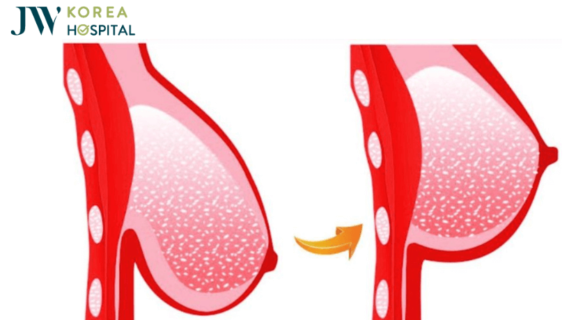 ngực chảy xệ sau sinh