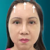 Treo chân mày nội soi 4x