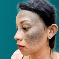 Trị Bớt