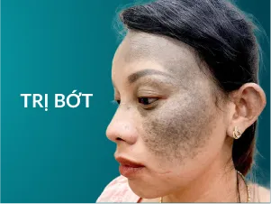 Trị Bớt