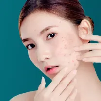 Trị Mụn