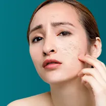 Trị Sẹo