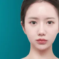 Bấm mí hàn quốc