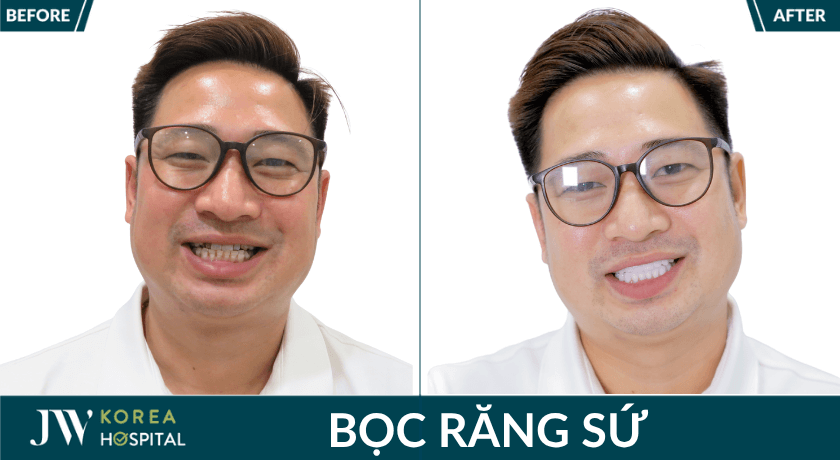 bọc răng sứ toàn hàm tại bệnh viện jw