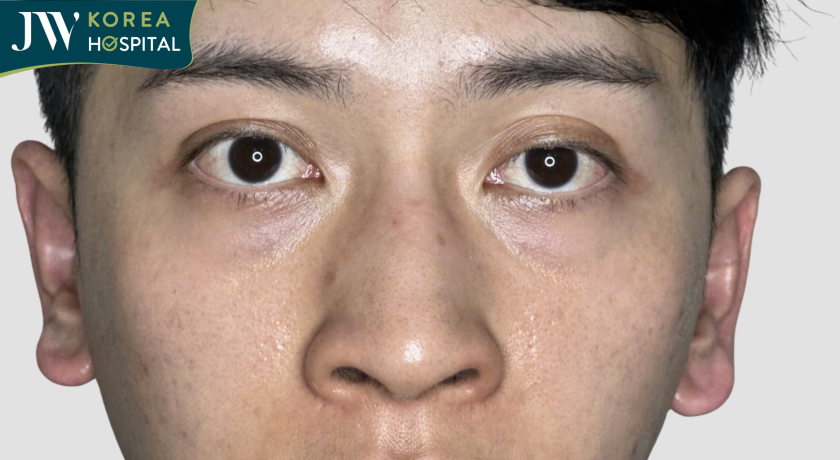 Chàng trai người úc gặp tình trạng mí sụp, sống mũi thấp trước khi đến với JW