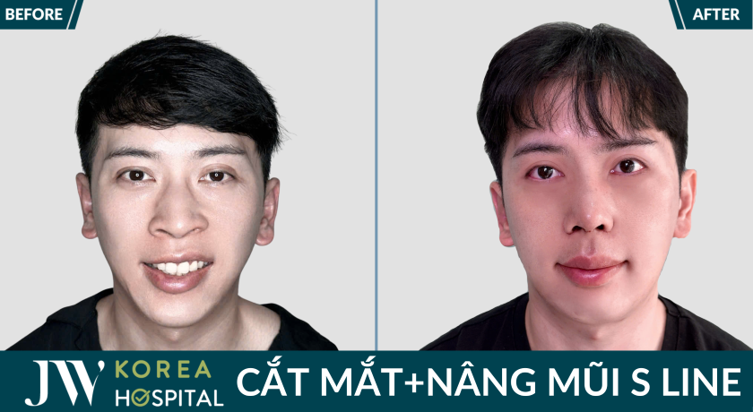 sở hữu mắt 2 mí rõ nét, mũi cao tự nhiên sau cắt mắt nâng mũi tại JW