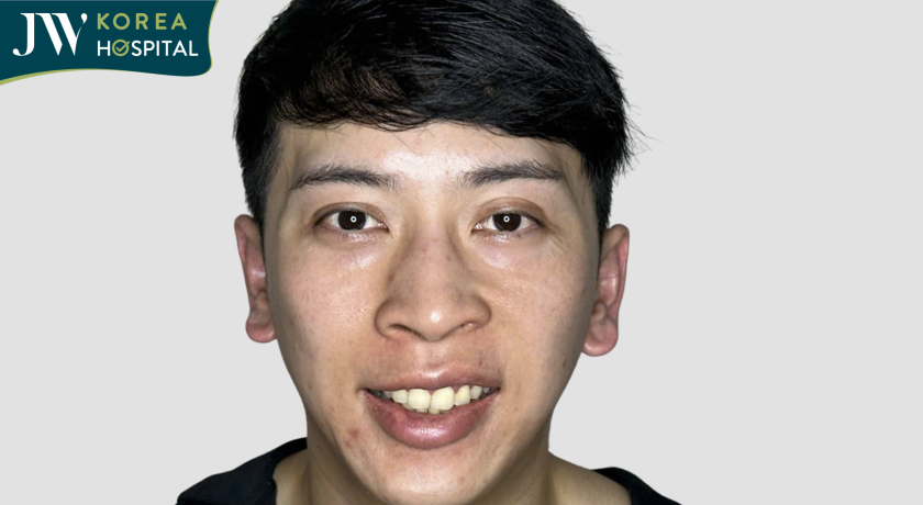 Hình ảnh của chàng trang người Úc trước khi đến cắt mắt nâng mũi tại JW