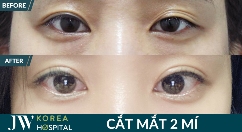 Mắt to tròn 2 mí rõ nét sau cắt mắt tại JW