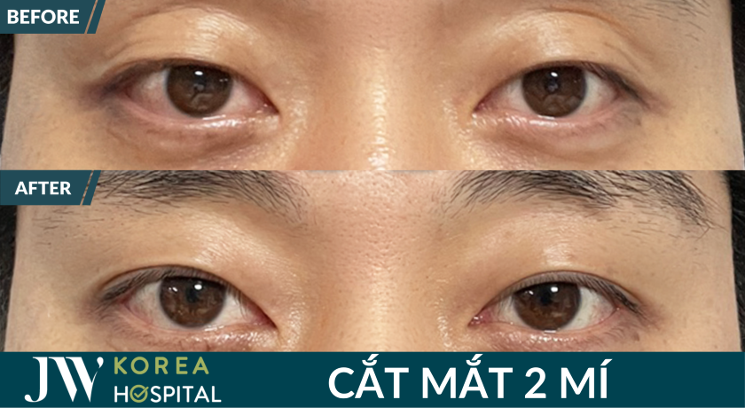 3 ngày hết sưng, 7 mgayf hết sẹo, mắt to trong long lanh sau cắt mắt 2 mí tại JW
