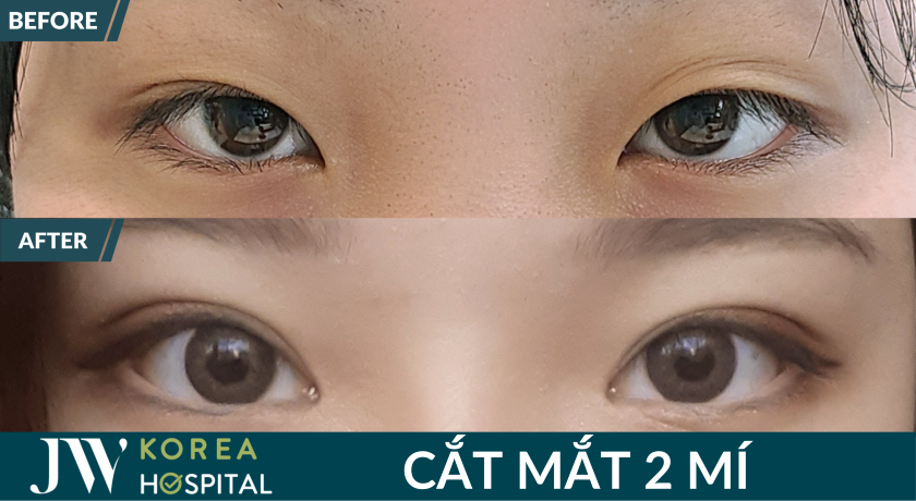 Mắt to tròn như búp bê sau 7 ngày cắt mắt 2 mí tại JW