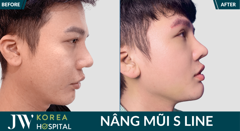 Nâng mũi S Line giúp sở hữu dáng mũi cao tự nhiên