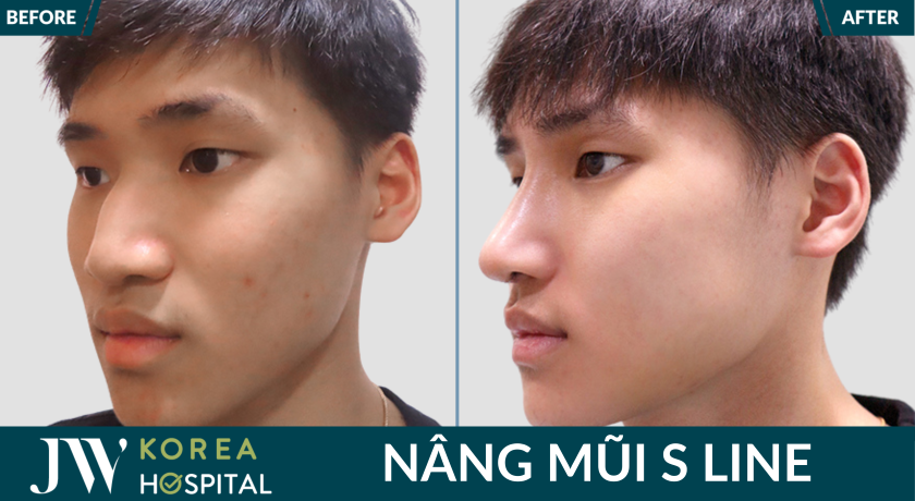 7 ngày sở hữu mũi cao tự nhiên nhờ nâng mũi S Line tại JW