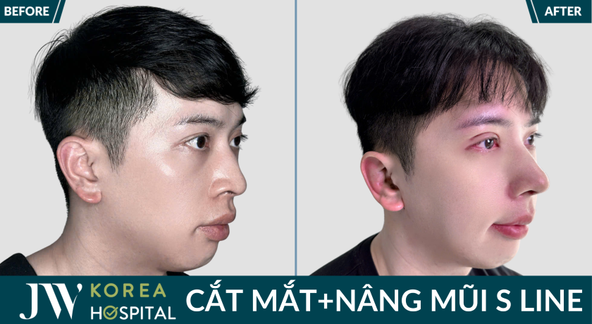 7 ngày sở hữu mắt to 2 mí, sống mũi cao tự nhiên nhờ cắt mắt nâng mũi tại JW