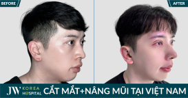 Chàng trai người Úc bay đến Việt Nam cắt mắt nâng mũi hóa soái ca sau 7 ngày tại JW