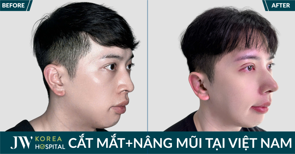 Cắt mắt nâng mũi tại Việt Nam – Quyết định táo bạo đã thay đổi cuộc đời của chàng trai người Úc