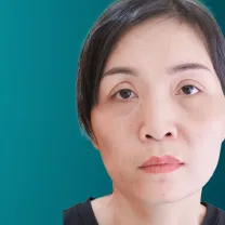 Chỉnh sửa mắt hỏng