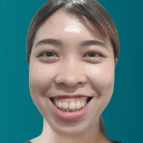 Chữa cười hở lợi