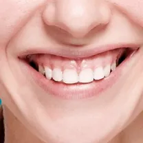 Chữa cười hở lợi
