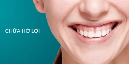 Chữa cười hở lợi