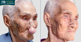 cụ bà 100 tuổi hé lộ diện mạo mới sau khi cắt bướu quỷ