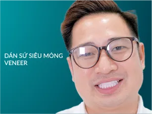 Dán sứ Veneer