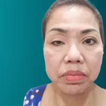 Điều trị sụp mí