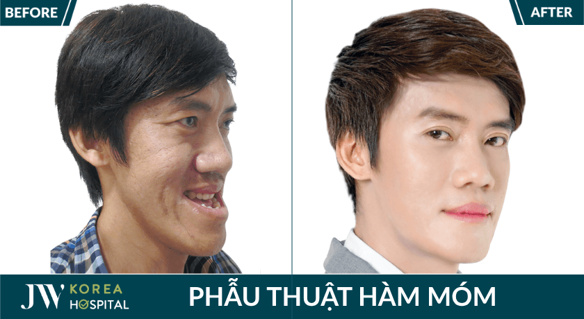 phẫu thuật hàm móm lêch khớp cắn tại JW
