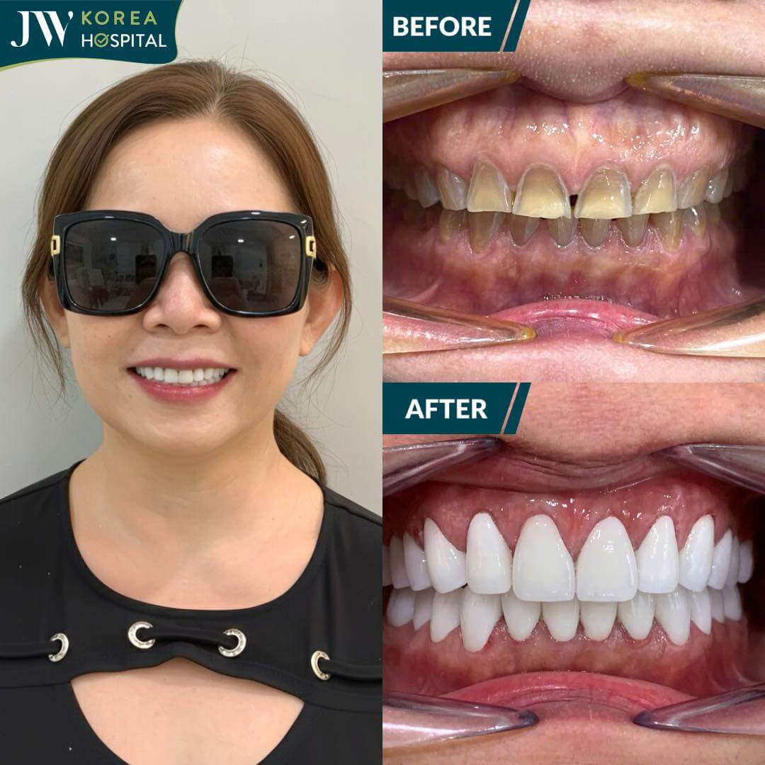 hình ảnh khách hàng trước và sau bọc răng sứ kim cương tại JW