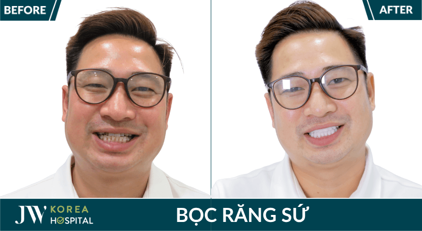 khách hàng bọc răng sứ kim cương jw diamond smile tại JW