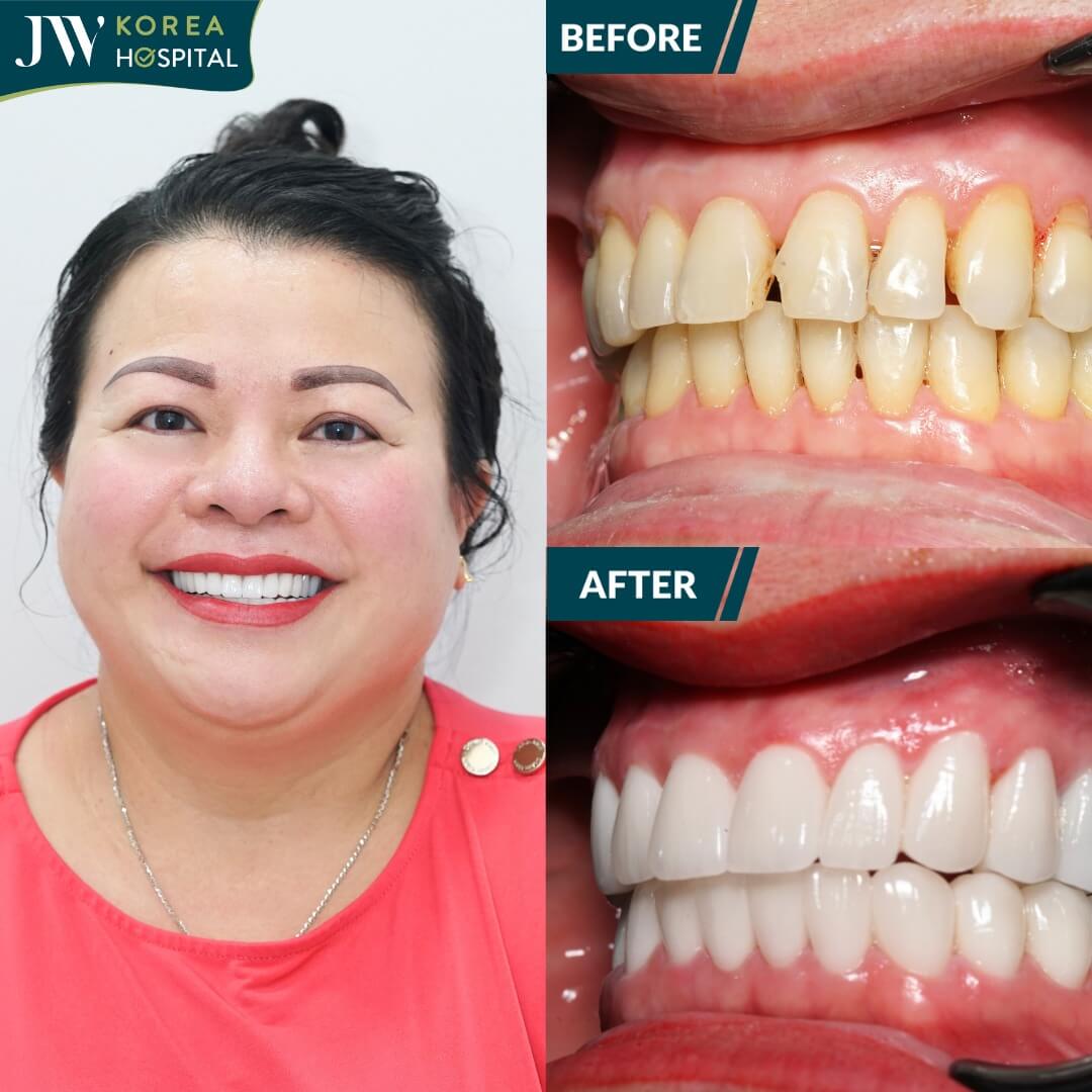 hình ảnh khách hàng trước và sau bọc răng sứ kim cương tại JW
